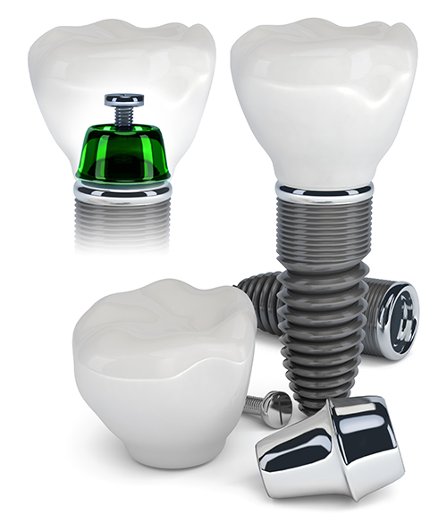 Cos Cob Dental Implants