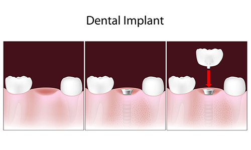 Dental Implants in Cos Cob