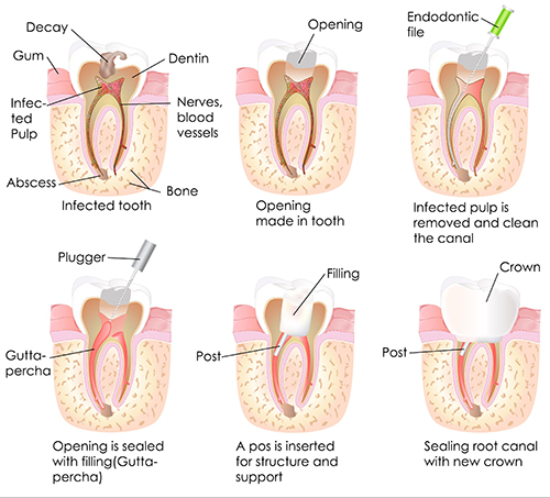 Root Canals in Cos Cob